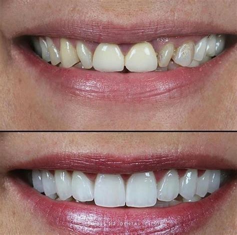 Veneers .
